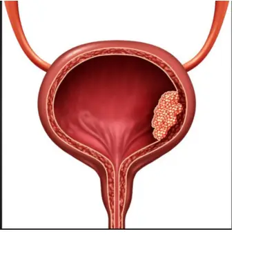 best-bladder-cancer-treatment-in-lucknow