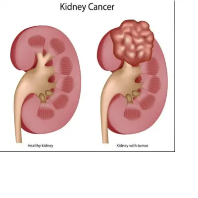 best-kidney-cancer-treatment-in-lucknow