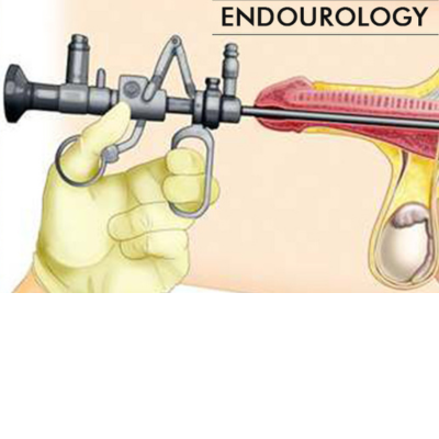 endourological-surgery-in-lucknow