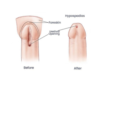 hypospadias-surgery-in-lucknow