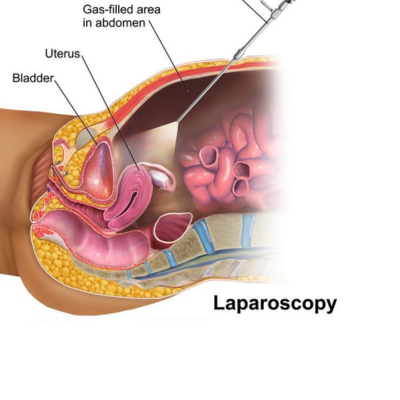 laparoscopic-surgery-in-lucknow