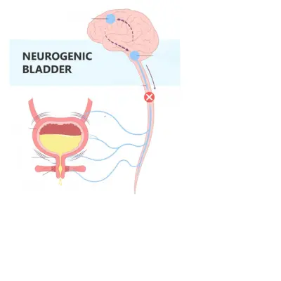 neurogenic-bladder-treatment-in-lucknow