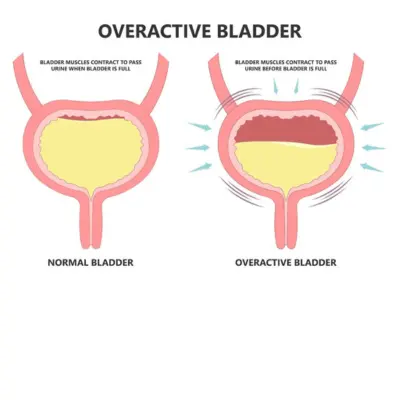 over-active-bladder-treatment-in-lucknow