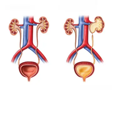 pelviureteric-junction-obstruction-pujo-treatment-in-lucknow