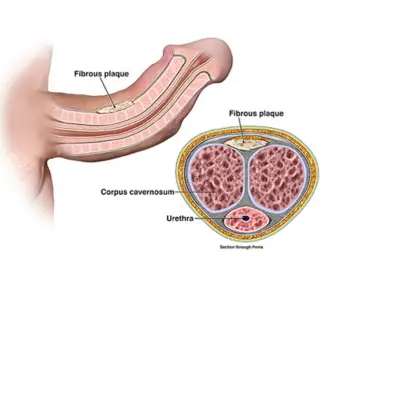 peyronie-disease-treatment-in-lucknow