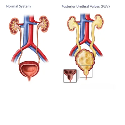 posterior-urethral-valve-puv-treatment-in-lucknow