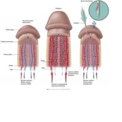 priapism-treatment-in-lucknow