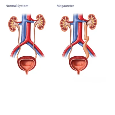 primary-obstructive-mega-ureter-pomu-treatment-in-lucknow