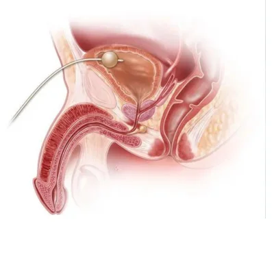 ruptured-urethra-treatment-in-lucknow