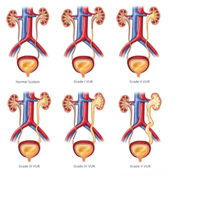 vesico-ureteric-reflux-vur-treatment-in-lucknow