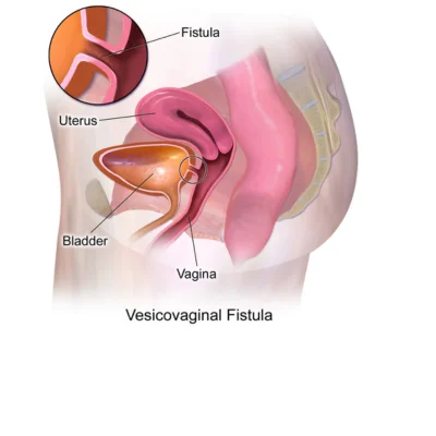 vesicovaginal-fistula-treatment-in-lucknow